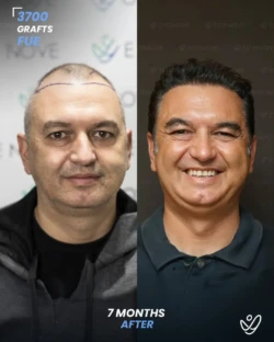 FUE Hair Transplant 3700 Grafts 7 Months Before&After FUE Hair Transplant 3700 Grafts 7 Months Before&After