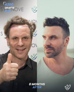 FUE Hair Transplant 4200 Grafts 8 Months Before&After FUE Hair Transplant 4200 Grafts 8 Months Before&After