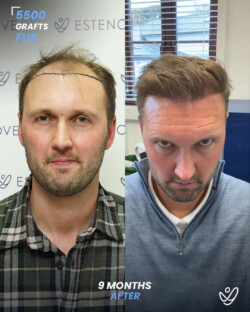 FUE Hair Transplant 5500 Grafts 9 Months Before&After FUE Hair Transplant 5500 Grafts 9 Months Before&After