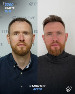 DHI Hair Transplant 3300 Grafts 9 Months Before&After DHI Hair Transplant 3300 Grafts 9 Months Before&After