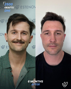 DHI Hair Transplant 2500 Grafts 6 Months Before&After DHI Hair Transplant 2500 Grafts 6 Months Before&After