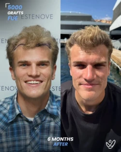 FUE Hair Transplant 5000 Grafts 6 Months Before&After FUE Hair Transplant 5000 Grafts 6 Months Before&After