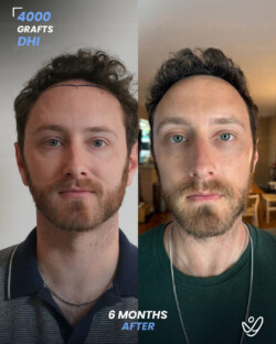 DHI Hair Transplant 4000 Grafts 6 Months Before&After