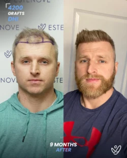 DHI Hair Transplant 4200 Grafts 9 Months Before&After DHI Hair Transplant 4200 Grafts 9 Months Before&After