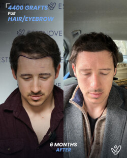 FUE Eyebrow & Hair Transplant 4400 Grafts 6 Months Before&After FUE Eyebrow & Hair Transplant 4400 Grafts 6 Months Before&After