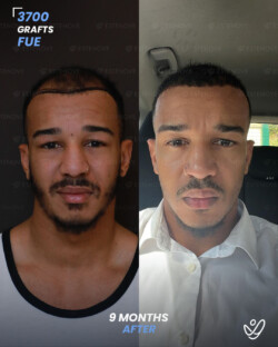 FUE Hair Transplant 3700 Grafts 9 Months Before&After FUE Hair Transplant 3700 Grafts 9 Months Before&After