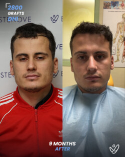 DHI Hair Transplant 2800 Grafts 9 Months Before&After DHI Hair Transplant 2800 Grafts 9 Months Before&After