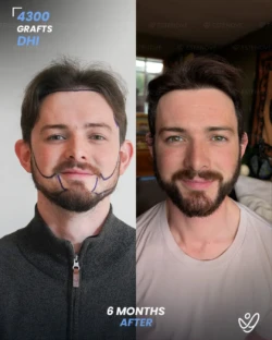 DHI Hair Transplant 4300 Grafts 6 Months Before&After DHI Hair Transplant 4300 Grafts 6 Months Before&After