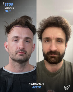 DHI Hair Transplant 3300 Grafts 6 Months Before&After DHI Hair Transplant 3300 Grafts 6 Months Before&After