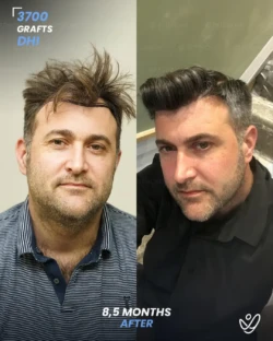DHI Hair Transplant 3700 Grafts 8.5 Months Before&After DHI Hair Transplant 3700 Grafts 8.5 Months Before&After