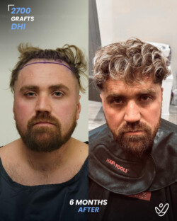 DHI Hair Transplant 2700 Grafts 6 Months Before&After DHI Hair Transplant 2700 Grafts 6 Months Before&After