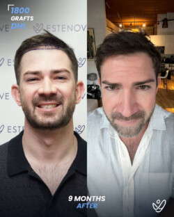 DHI Hair Transplant 1800 Grafts 9 Months Before&After DHI Hair Transplant 1800 Grafts 9 Months Before&After