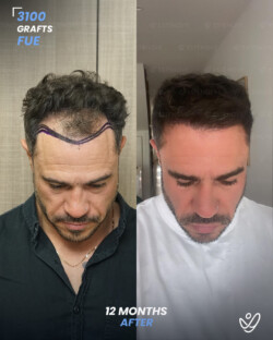 FUE Hair Transplant 3100 Grafts 12 Months Before&After FUE Hair Transplant 3100 Grafts 12 Months Before&After