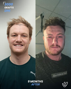 DHI Hair Transplant 3000 Grafts 9 Months Before&After DHI Hair Transplant 3000 Grafts 9 Months Before&After