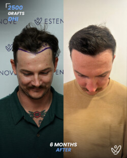 DHI Hair Transplant 2500 Grafts 6 Months Before&After DHI Hair Transplant 2500 Grafts 6 Months Before&After