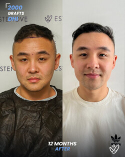 DHI Hair Transplant 2000 Grafts 12 Months Before&After DHI Hair Transplant 2000 Grafts 12 Months Before&After