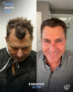 FUE Hair Transplant 3850 Grafts 9 Months Before&After FUE Hair Transplant 3850 Grafts 9 Months Before&After