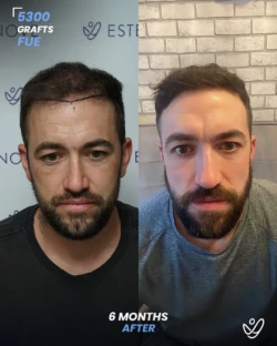 FUE Hair Transplant 5300 Grafts 6 Months Before&After FUE Hair Transplant 5300 Grafts 6 Months Before&After