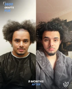 FUE Hair Transplant 3600 Grafts 9 Months Before&After FUE Hair Transplant 3600 Grafts 9 Months Before&After