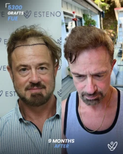 FUE Hair Transplant 5300 Grafts 9 Months Before&After FUE Hair Transplant 5300 Grafts 9 Months Before&After