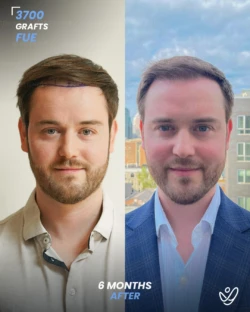 FUE Hair Transplant 3700 Grafts 6 Months Before&After FUE Hair Transplant 3700 Grafts 6 Months Before&After