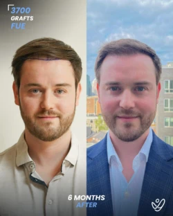 FUE Hair Transplant 3700 Grafts 6 Months Before&After FUE Hair Transplant 3700 Grafts 6 Months Before&After