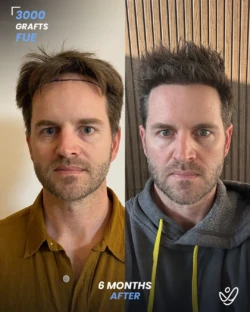 FUE Hair Transplant 3000 Grafts 6 Months Before&After FUE Hair Transplant 3000 Grafts 6 Months Before&After