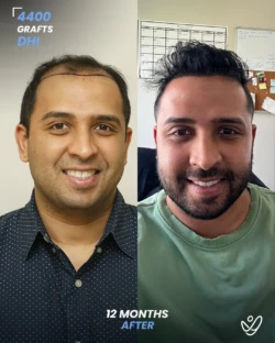 DHI Hair Transplant 4400 Grafts 12 Months Before&After DHI Hair Transplant 4400 Grafts 12 Months Before&After