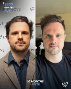 FUE Hair Transplant 3600 Grafts 10 Months Before&After FUE Hair Transplant 3600 Grafts 10 Months Before&After