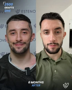 DHI Hair Transplant 2500 Grafts 6 Months Before&After DHI Hair Transplant 2500 Grafts 6 Months Before&After