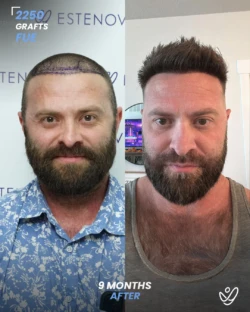 FUE Hair Transplant 2250 Grafts 9 Months Before&After FUE Hair Transplant 2250 Grafts 9 Months Before&After