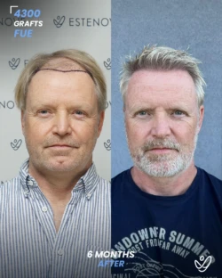 FUE Hair Transplant 4300 Grafts 6 Months Before&After FUE Hair Transplant 4300 Grafts 6 Months Before&After