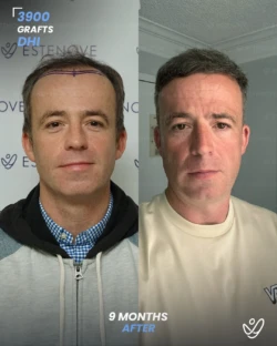 DHI Hair Transplant 3900 Grafts 9 Months Before&After DHI Hair Transplant 3900 Grafts 9 Months Before&After