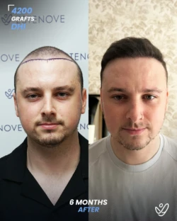 DHI Hair Transplant 4200 Grafts 6 Months Before&After DHI Hair Transplant 4200 Grafts 6 Months Before&After