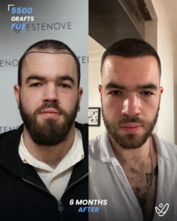 FUE Hair Transplant 5500 Grafts 6 Months Before&After FUE Hair Transplant 5500 Grafts 6 Months Before&After