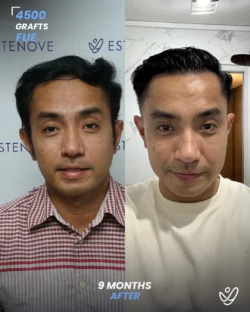 FUE Hair Transplant 4500 Grafts 9 Months Before&After FUE Hair Transplant 4500 Grafts 9 Months Before&After