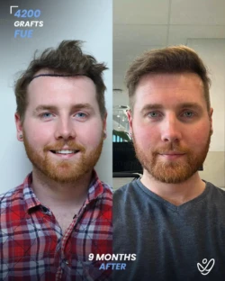 FUE Hair Transplant 4200 Grafts 9 Months Before&After FUE Hair Transplant 4200 Grafts 9 Months Before&After