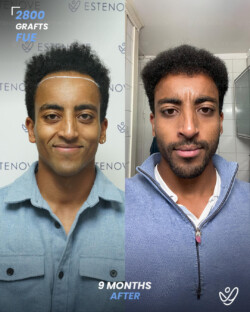FUE Hair Transplant 2800 Grafts 9 Months Before&After FUE Hair Transplant 2800 Grafts 9 Months Before&After