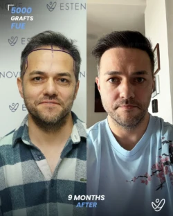 FUE Hair Transplant 5000 Grafts 9 Months Before&After FUE Hair Transplant 5000 Grafts 9 Months Before&After