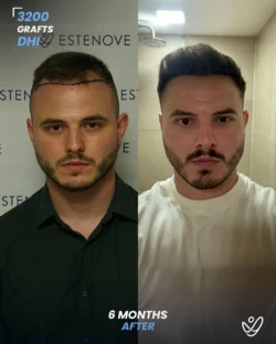 DHI Hair Transplant 3200 Grafts 6 Months Before&After DHI Hair Transplant 3200 Grafts 6 Months Before&After
