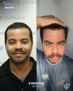 FUE Hair Transplant 2600 Grafts 6 Months Before&After FUE Hair Transplant 2600 Grafts 6 Months Before&After
