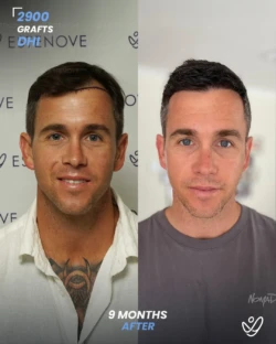DHI Hair Transplant 2900 Grafts 9 Months Before&After DHI Hair Transplant 2900 Grafts 9 Months Before&After
