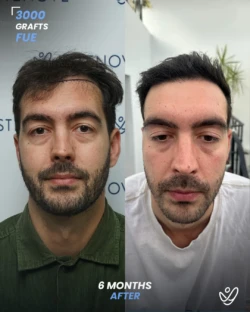 FUE Hair Transplant 3000 Grafts 6 Months Before&After FUE Hair Transplant 3000 Grafts 6 Months Before&After
