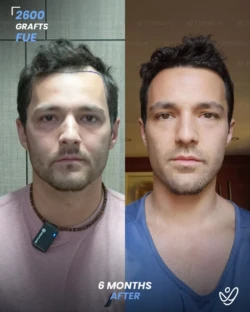 FUE Hair Transplant 2600 Grafts 6 Months Before&After FUE Hair Transplant 2600 Grafts 6 Months Before&After