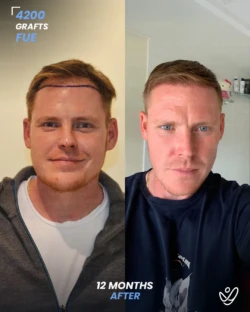 FUE Hair Transplant 4200 Grafts 12 Months Before&After FUE Hair Transplant 4200 Grafts 12 Months Before&After