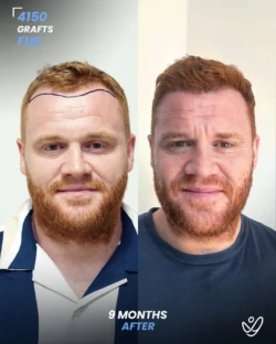 FUE Hair Transplant 4150 Grafts 9 Months Before&After FUE Hair Transplant 4150 Grafts 9 Months Before&After