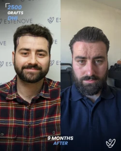 DHI Hair Transplant 2500 Grafts 9 Months Before&After DHI Hair Transplant 2500 Grafts 9 Months Before&After