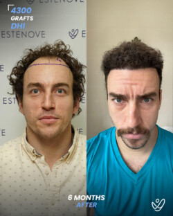 DHI Hair Transplant 4300 Grafts 6 Months Before&After DHI Hair Transplant 4300 Grafts 6 Months Before&After