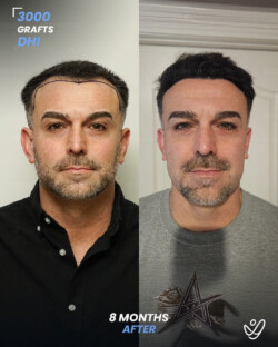 DHI Hair Transplant 3000 Grafts 8 Months Before&After DHI Hair Transplant 3000 Grafts 8 Months Before&After