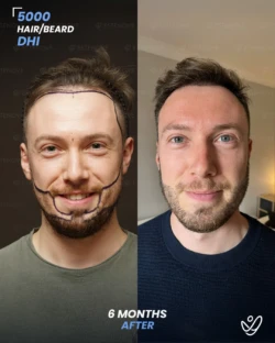 DHI Beard & Hair Transplant 5000 Grafts 6 Months Before&After DHI Beard & Hair Transplant 5000 Grafts 6 Months Before&After